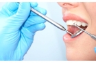 Удаление наддесневых и поддесневых зубных отложений
