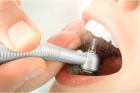Пломбирование корневого канала зуба пастой